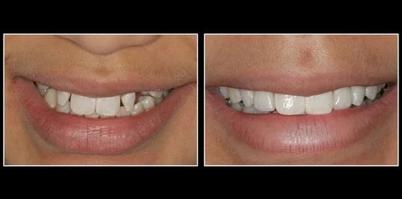 dental crowns before and after in lansing, mi smiles by stone