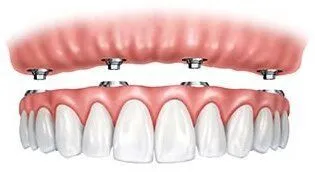 illustration of full upper denture being attached in mouth with dental implants Beverly Hills, MI implant dentist