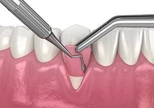 illustration of dental tools placing soft tissue gum graft in mouth, gum grafting periodontics Melrose, MA dentist