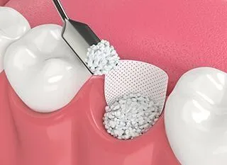 illustration of dental tool adding bone grafting material to tooth socket, bone grafting periodontics Melrose dentist