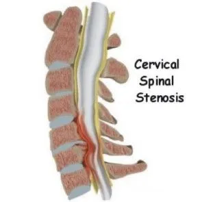 lumbar_stenosis_intro01.jpg