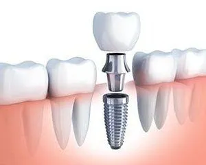 illustration of dental implant parts and assembly in mouth with teeth and gums, dental implants Charlotte, NC implant dentistry