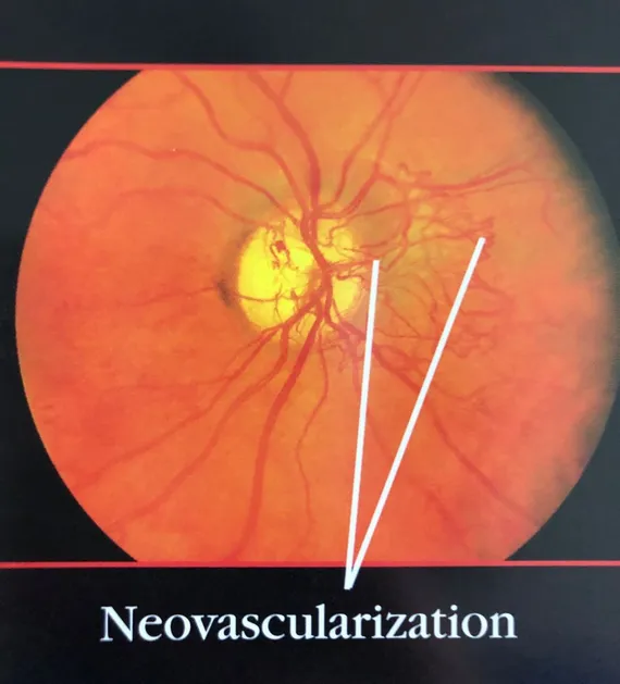 Neovascularization