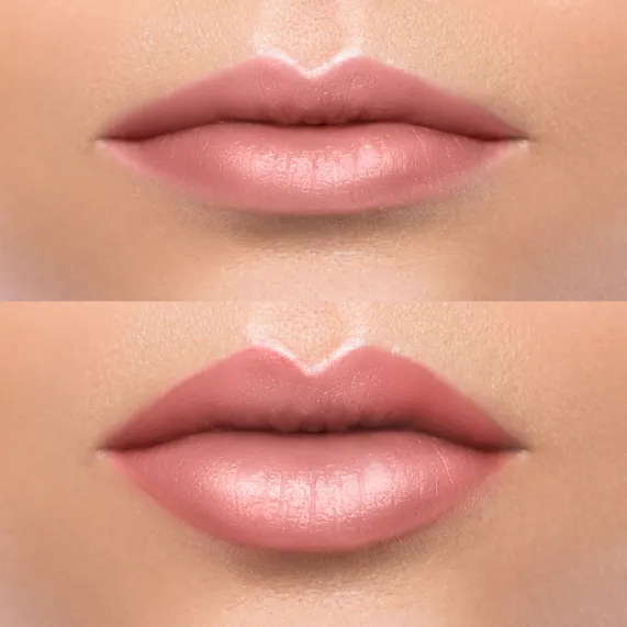 lip before and after