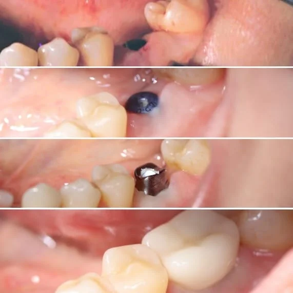 series of four images showing progression of missing tooth in mouth, then hole drilled for implant, then embedded implant post, then implant crown in place in final image. dental implants dentist New Baltimore, MI