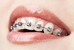 woman's mouth smiling revealing braces on teeth, straighten teeth Milford, MI orthodontics