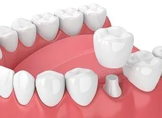 3D illustration of teeth in mouth, dental crown being placed over tooth, one visit dental crowns Wauwatosa, WI dentist