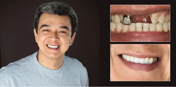 dental crowns before and after lansing, mi dentist