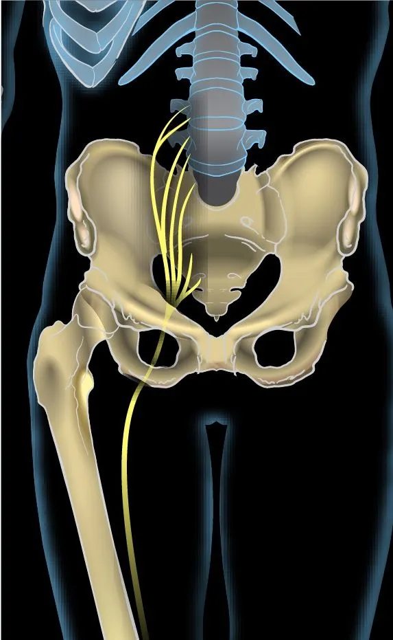 Sciatica Treatment NYC  Sciatica Doctors New York City