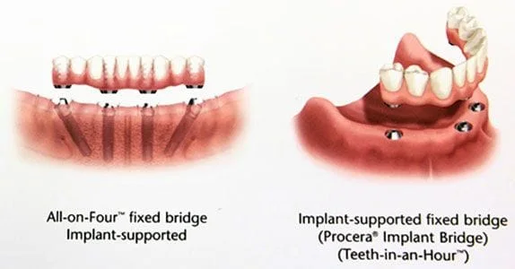 Implant Removable Options