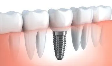 illustration of row of teeth with embedded dental implant, implant dentistry Brookline, MA dental implants dentist