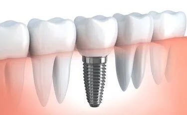 illustration of teeth in gums showing roots and embedded dental implants Lawrenceville, GA dentist