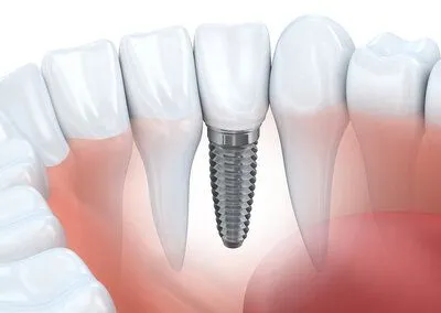 illustration of teeth in mouth with embedded implant, dental implants Seminole, FL dentist