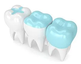 illustration of three teeth, showing example of inlay, onlay, and crown, dentist Philadelphia, PA general dentistry