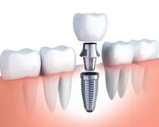 illustration of dental implant parts and assembly replacing missing tooth, dental implants Sherman Oaks, CA dentist