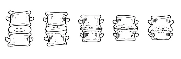 disc degenerating over time from lack of movement