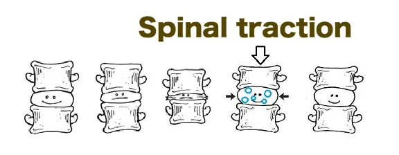 spinal traction reversing degeneration of the spine