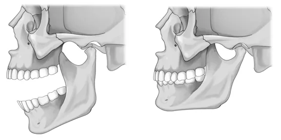 TMJ opening for jaw pain TMJ chiropractor