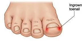 ingrown_toenail.jpg