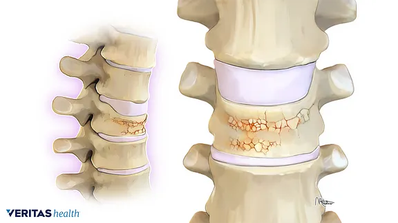 Illustration of a vertebral compression fracture