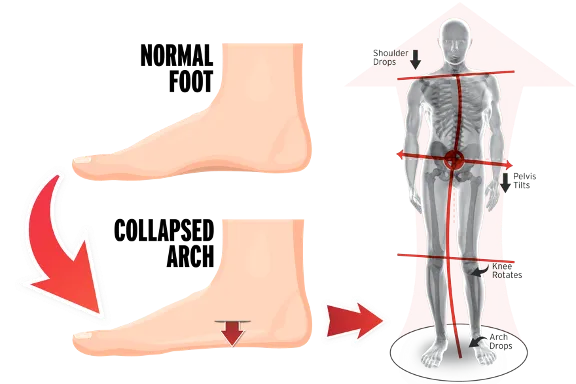over pronation consequences
