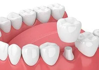 3D illustration of teeth and gums, dental crown being fitted over prepared tooth, dentist Frederick, MD 