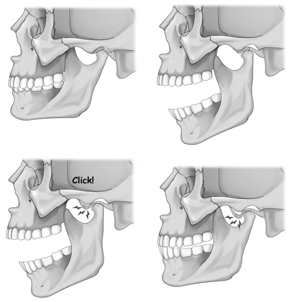 jaw (TMD) clicking for jaw pain TMJ chiropractor