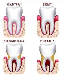 diagram showing stages of gum disease on teeth, dentist Newark, CA gum disease treatment