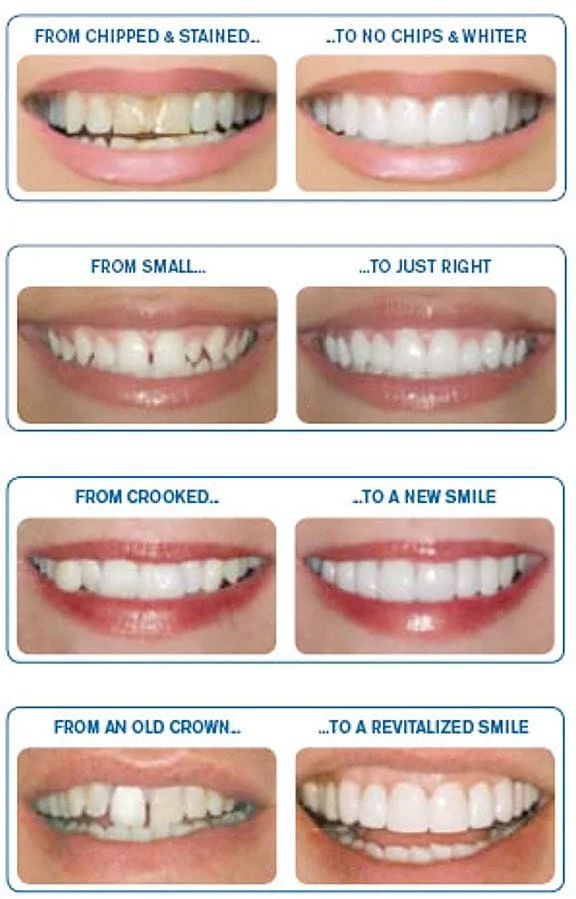 Dental Veneers Cedar Rapids, IA