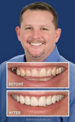 before and after image of man's teeth with smile makeover, cosmetic dentistry Washington, DC dentist