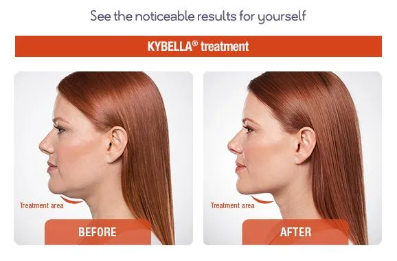 Kybella