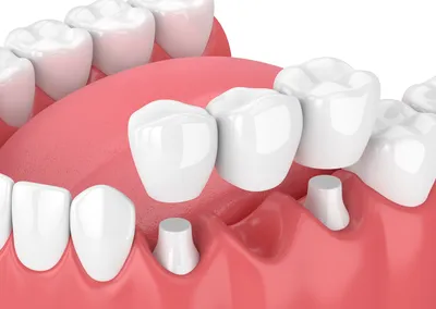 3D illustration of teeth and gums, 3 unit dental bridge being placed over abutment teeth, family dentist Frederick, MD general dentistry