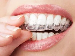 woman's hand placing clear aligner tray in mouth, Invisalign Beverly Grove Los Angeles, CA cosmetic dentist