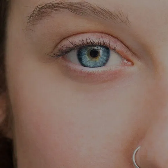 Red Eye Exams and Treatment