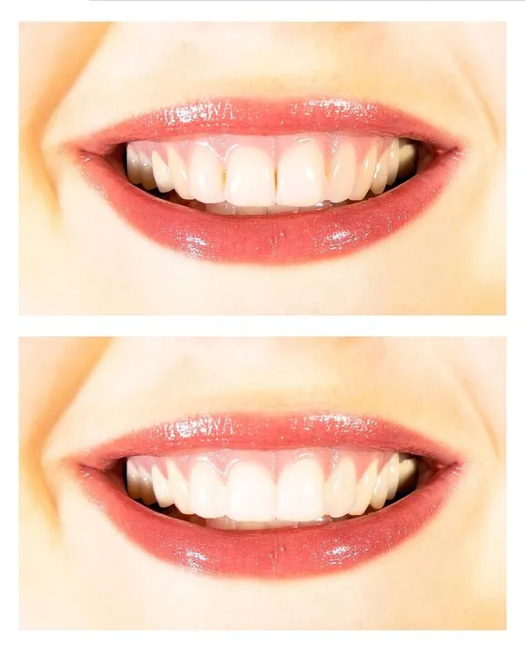 Teeth Whitening Washington DC