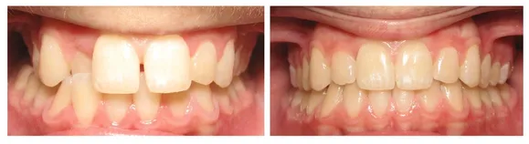 Invisalign dental transformation in Finksburg, MD