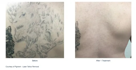 Bad Ink Tattoo Removal a Burgeoning Industry