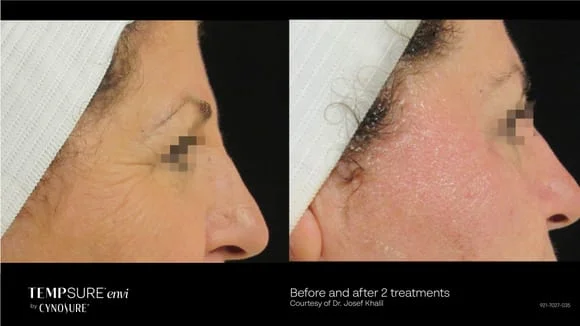 Crows Feet TempSure Envi Before and After