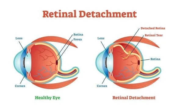 Retinal Detchment Diagram