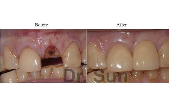 Cupertino dental implants before and after
