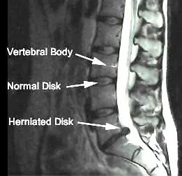 stenosis_MRI_1.jpg