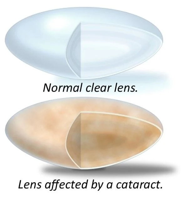 Cataract Lens comparison