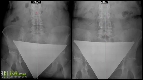 Xray Image