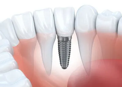 illustration of teeth and roots in jaw, embedded implant next to teeth, dental implants Roslyn, NY dentist