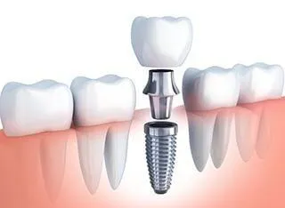 illustration of dental implant parts replacing missing tooth, dentist Wicker Park dental implants Bucktown Chicago, IL
