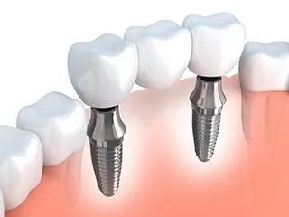 illustration of fixed implant bridge replacing teeth, dental implants University City, MO cosmetic dentist