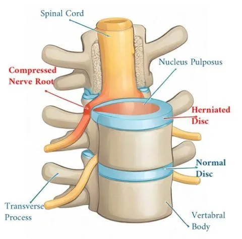 herniated disc