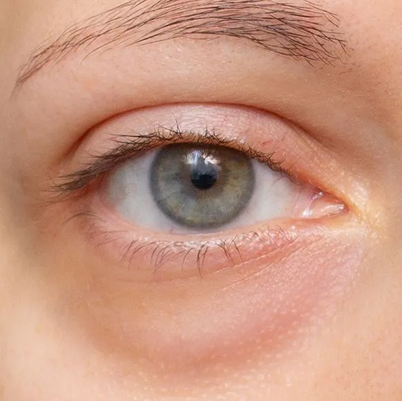 IPL FOR OTHER CONDITIONS