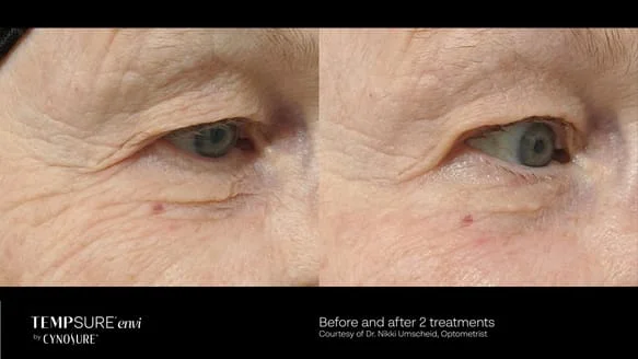 Dermatochalasis eyelids TempSure Envi Before and After
