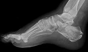 xray feet